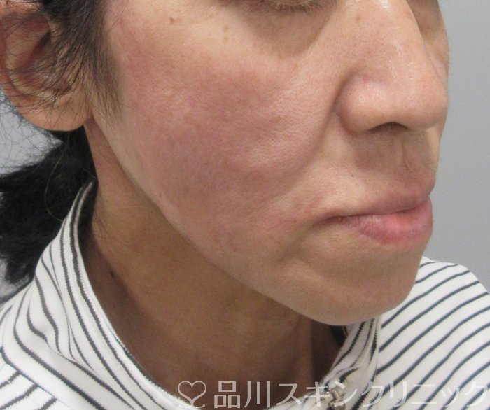 症例NO.74132のAFTER写真