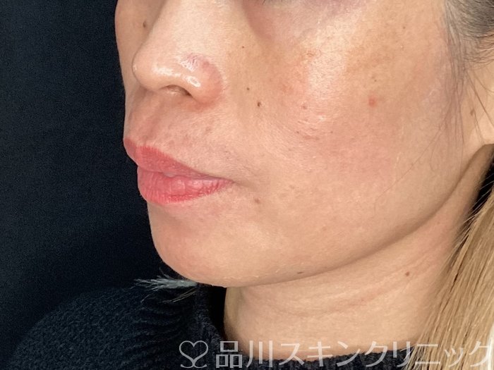 症例NO.72661のBEFORE写真