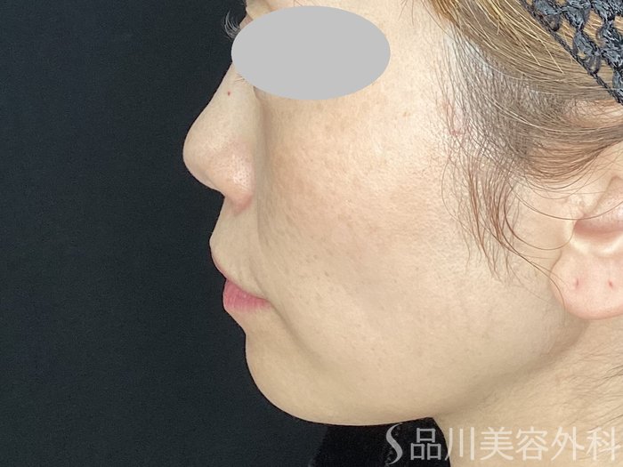 症例NO.72541のBEFORE写真