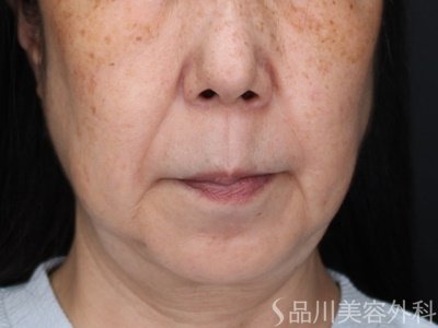 症例NO.71793のBEFORE写真