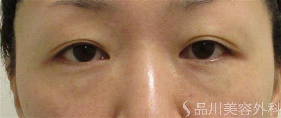 症例NO.55230のBEFORE写真