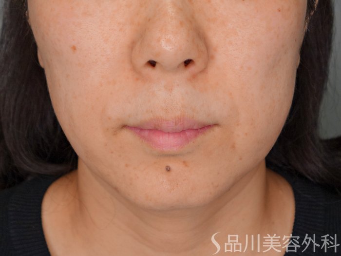 症例NO.70608のBEFORE写真