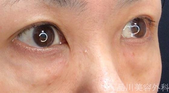 症例NO.59176のBEFORE写真