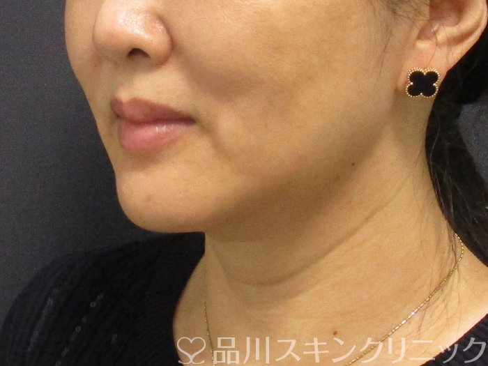 症例NO.69280のAFTER写真