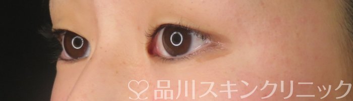 症例NO.65859のBEFORE写真