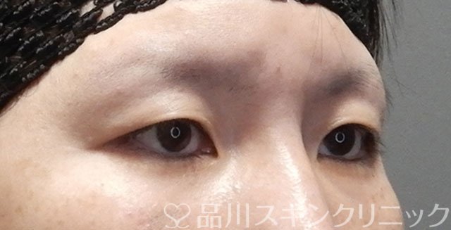症例NO.75077のBEFORE写真