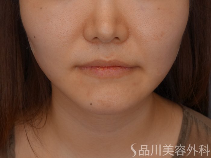 症例NO.72434のAFTER写真