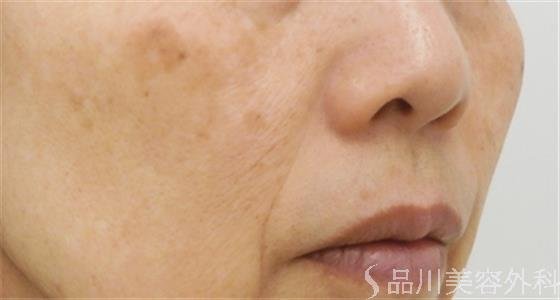 症例NO.20790のAFTER写真