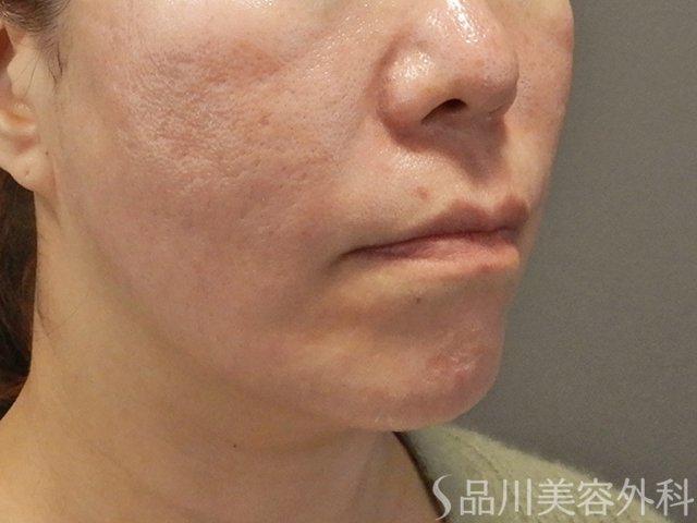 症例NO.73132のAFTER写真