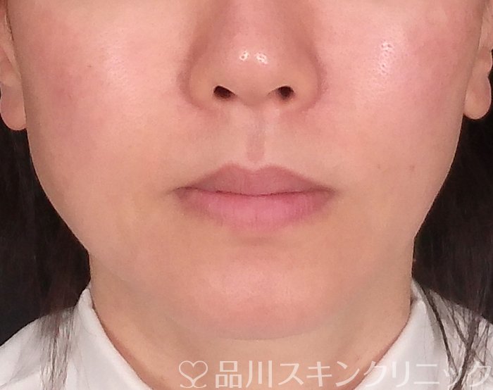 症例NO.69488のBEFORE写真