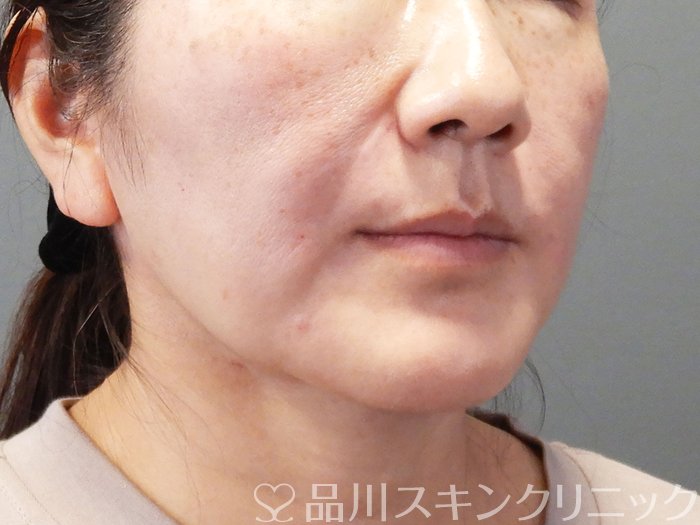 症例NO.74189のAFTER写真