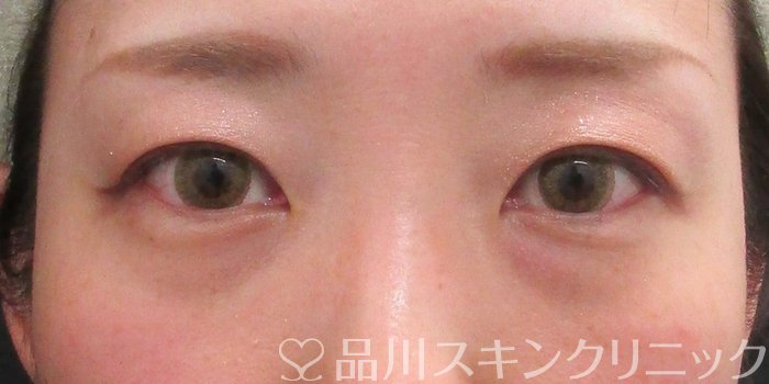 症例NO.70406のBEFORE写真