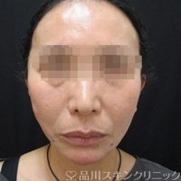 症例NO.71572のAFTER写真