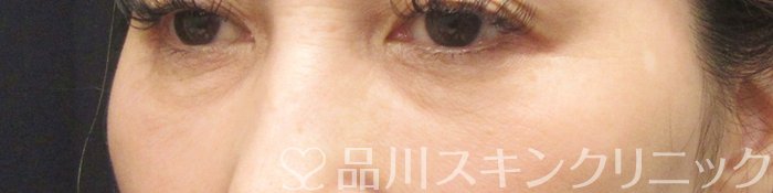 症例NO.67574のBEFORE写真