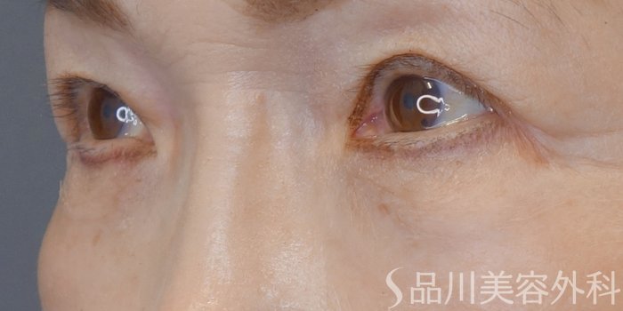 症例NO.72206のAFTER写真