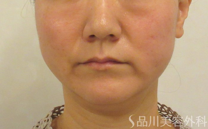 症例NO.71577のAFTER写真