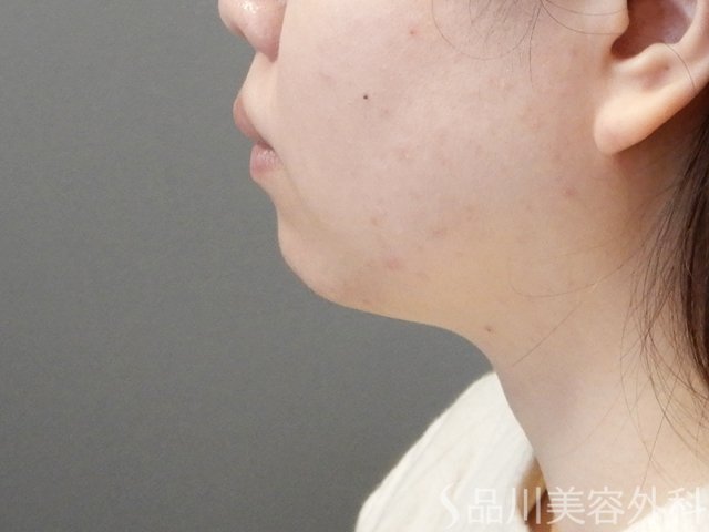 症例NO.67998のBEFORE写真