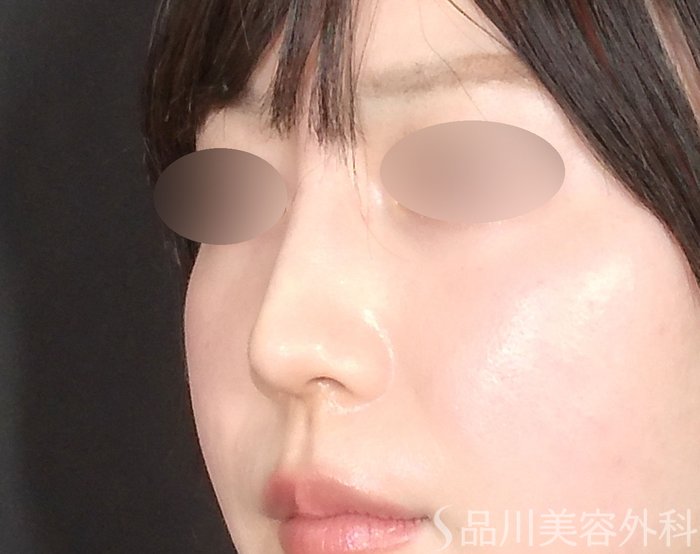 症例NO.71999のAFTER写真