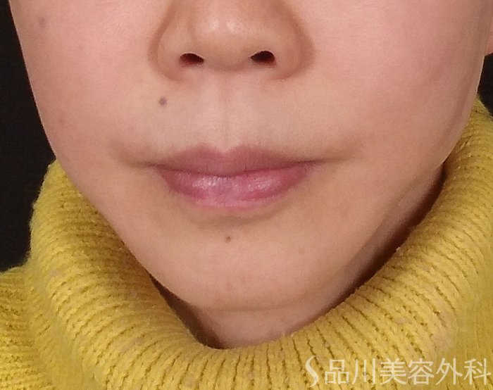 症例NO.69387のAFTER写真