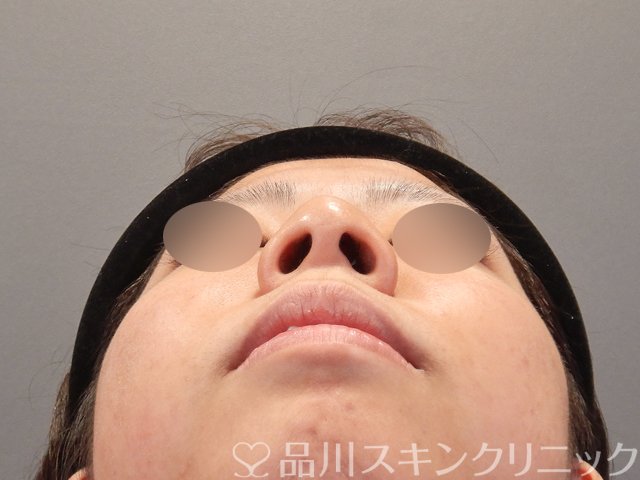 症例NO.75198のBEFORE写真