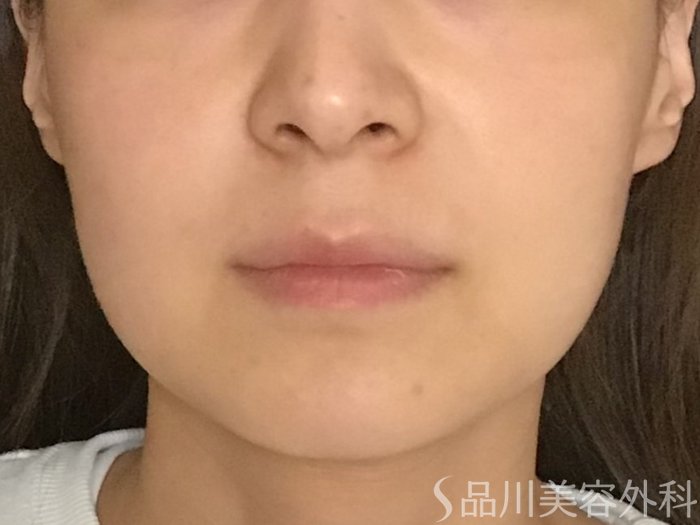症例NO.65298のBEFORE写真