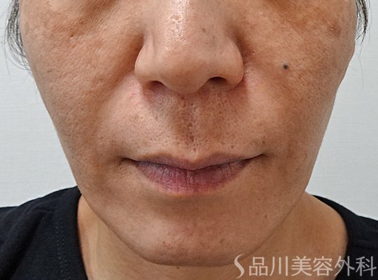 症例NO.65604のAFTER写真
