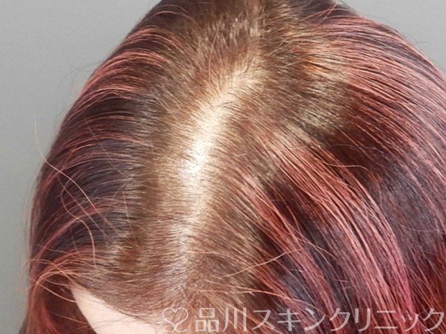 症例NO.69020のBEFORE写真