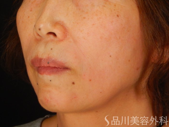 症例NO.68157のAFTER写真