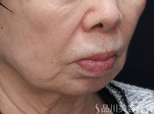 症例NO.73761のBEFORE写真