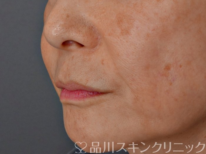 症例NO.72580のBEFORE写真