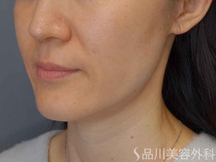 症例NO.72283のBEFORE写真