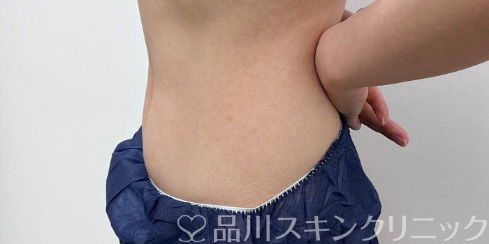 症例NO.69949のAFTER写真