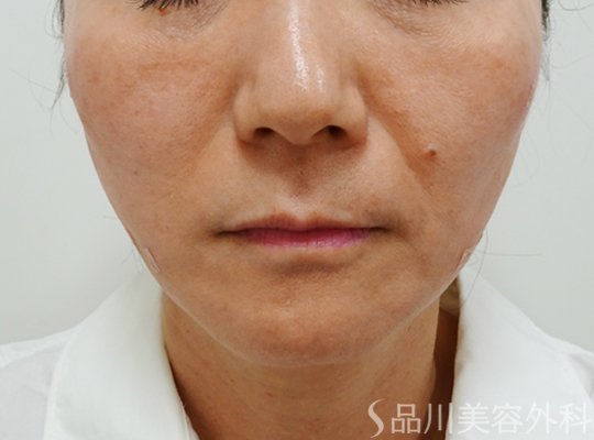 症例NO.73119のAFTER写真