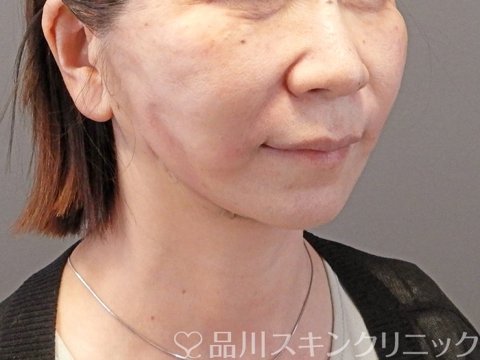 症例NO.66252のAFTER写真