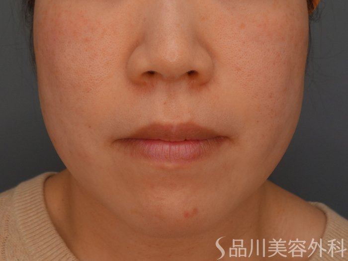 症例NO.75389のBEFORE写真
