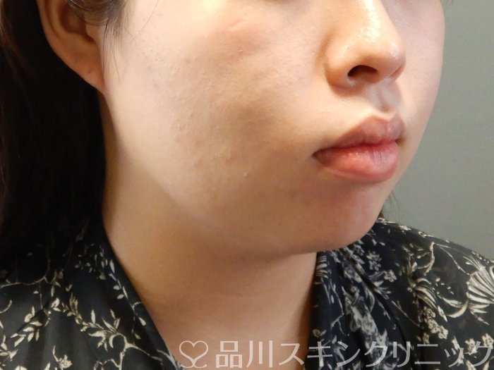 症例NO.62168のBEFORE写真