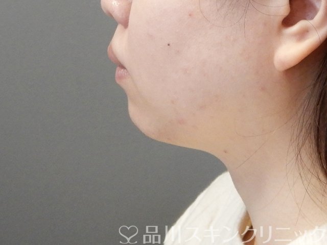 症例NO.67998のBEFORE写真