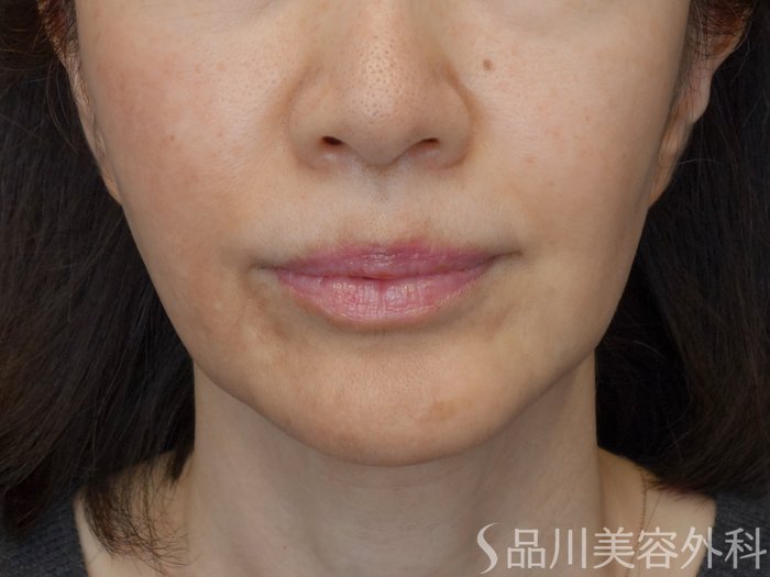 症例NO.72609のBEFORE写真