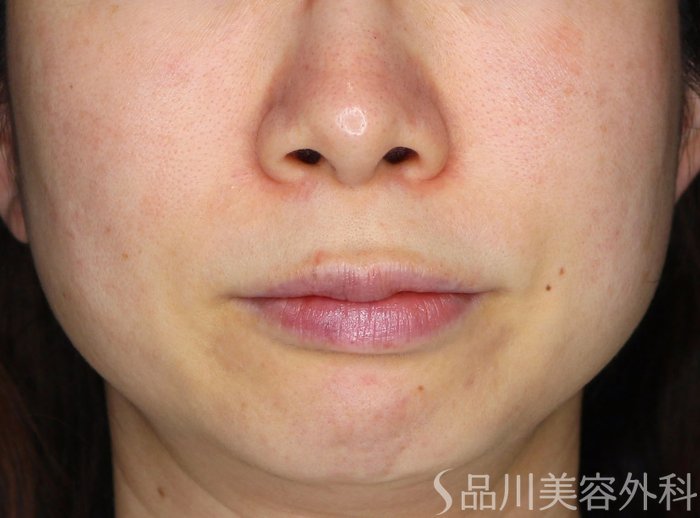 症例NO.69618のBEFORE写真