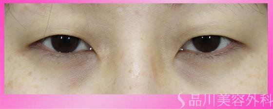 症例NO.51568のBEFORE写真