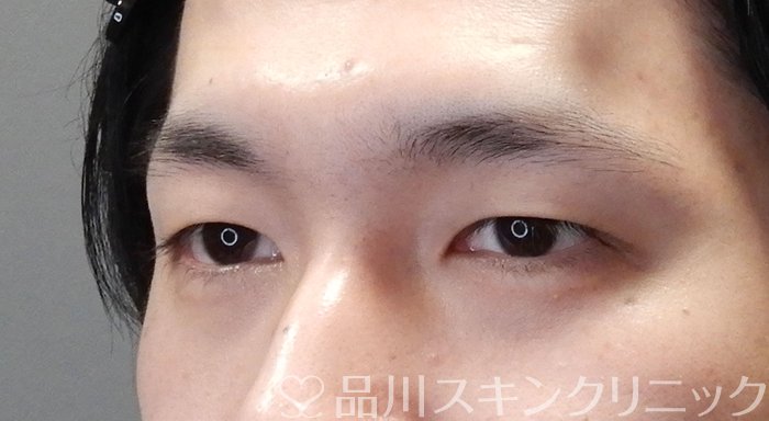 症例NO.70659のBEFORE写真