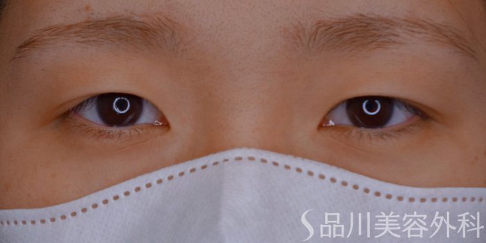 症例NO.74364のBEFORE写真