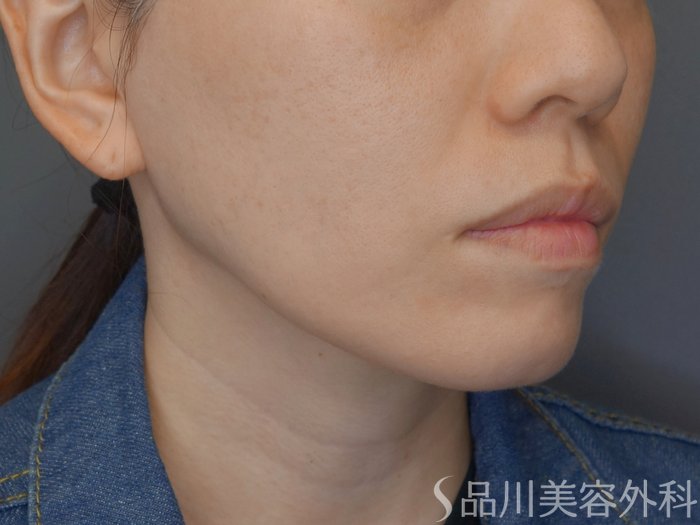 症例NO.71646のBEFORE写真
