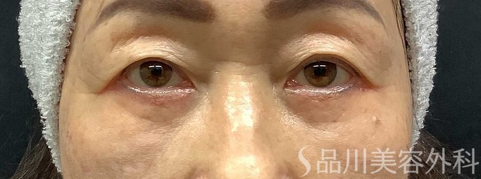 症例NO.69668のAFTER写真