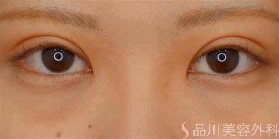 症例NO.58986のAFTER写真