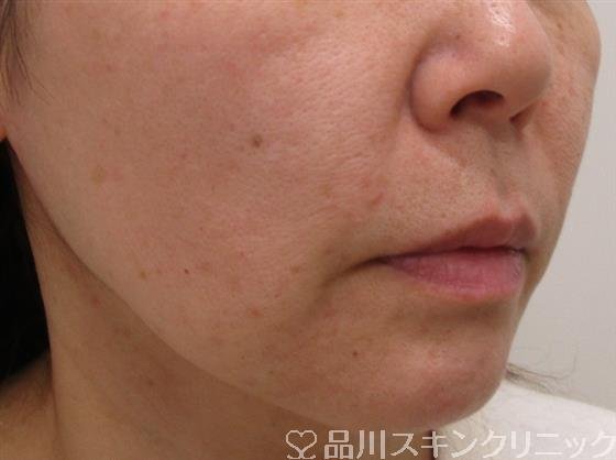 症例NO.41629のAFTER写真