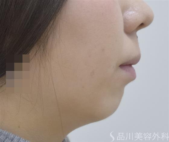 症例NO.46845のBEFORE写真