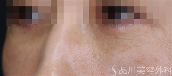 症例NO.61694のAFTER写真