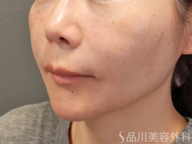 症例NO.74471のAFTER写真