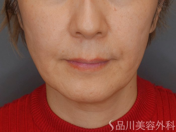 症例NO.72338のBEFORE写真